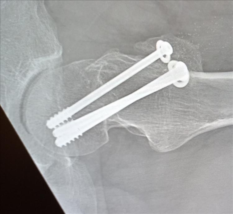 X ray showing a hip with 3 screws in the neck of femur and arthritis