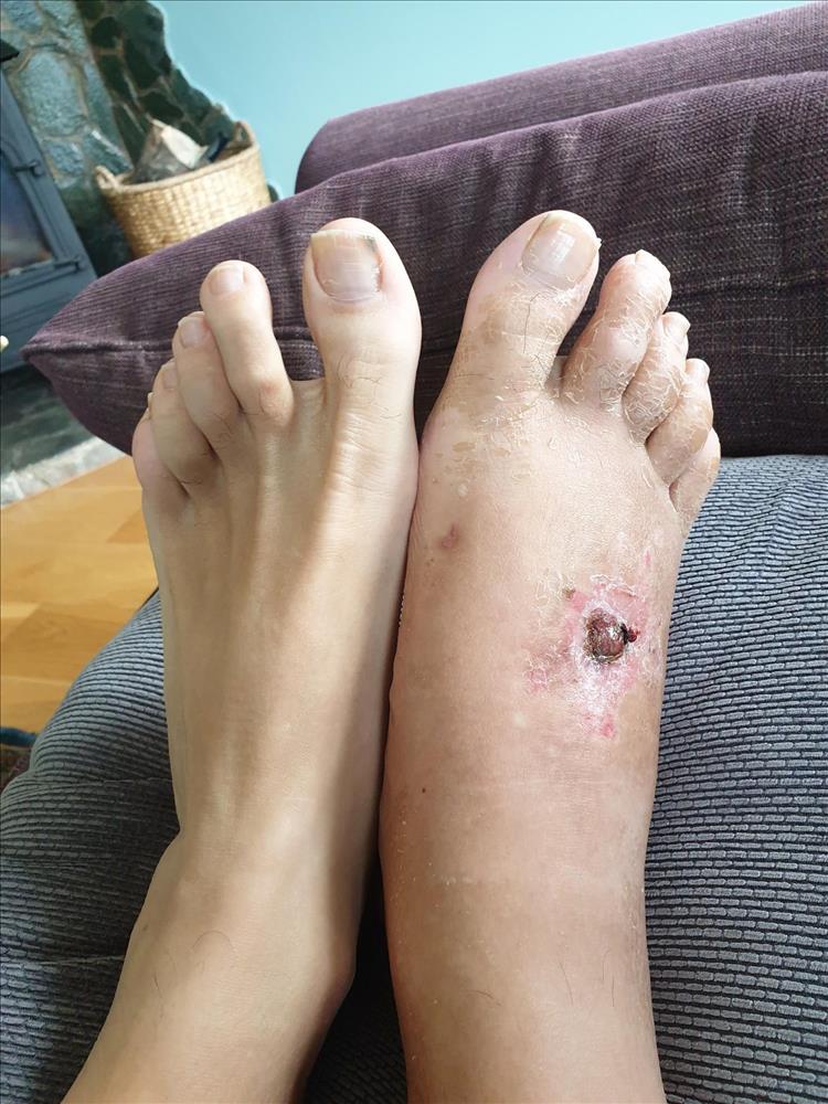 Both pete's feet, one swollen but without pins is getting better and looking better
