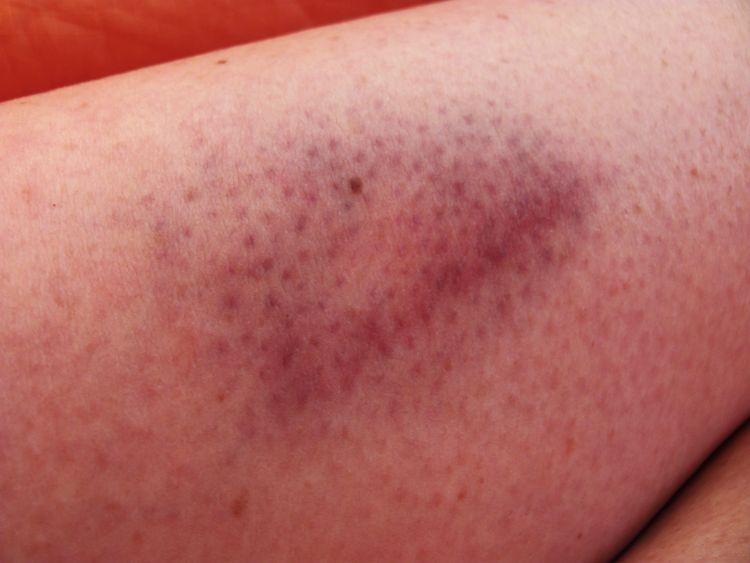 Sharon's leg shows a large red and blue bruise coming out to the skin